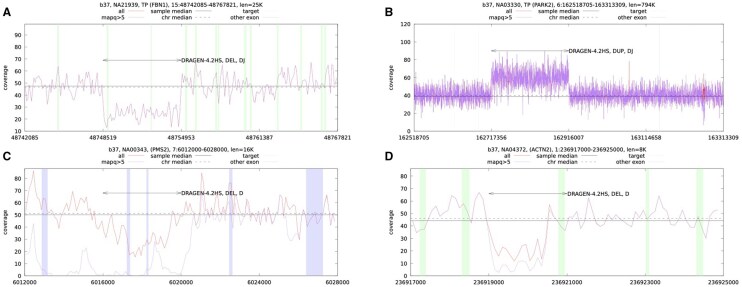 Four coverage plots from De La Vega et al. showing DRAGEN calls: a true deletion in FBN1 and a true duplication in PARK2 supported by depth and junction reads, a false deletion near the PMS2CL pseudogene, and a real ACTN2 deletion scored false because its breakpoint was over-extended into an exon